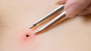 KKKA Alarmı: Yağışlı Kış Kene Sayısını Artırabilir!