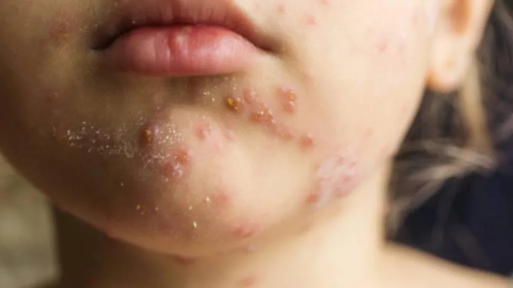 Prof. Dr. Ateş Kara’dan Kritik Kızamık ve Aşı Uyarısı