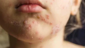 Prof. Dr. Ateş Kara’dan Kritik Kızamık ve Aşı Uyarısı