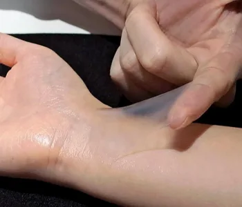 Kan Dolaşımmı Olan Yapay Deri Dokusu Üretildi