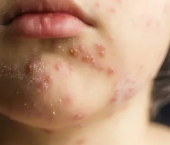 Prof. Dr. Ateş Kara’dan Kritik Kızamık ve Aşı Uyarısı