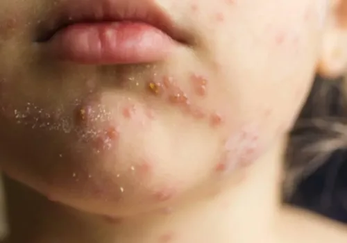 Prof. Dr. Ateş Kara’dan Kritik Kızamık ve Aşı Uyarısı